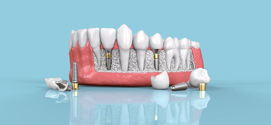 Dental Implants 101: All That You Should Know About This Excellent Dental Solution