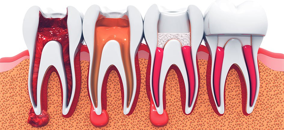Root Canal Treatment 101: Everything That You Need to Know | Dentologem