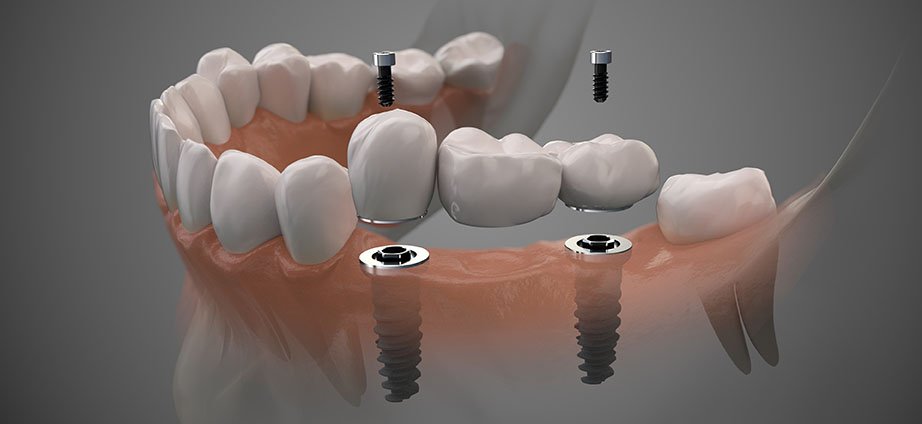 Tooth Bridges Explained: Everything That You Need to Know About This Dental Solution